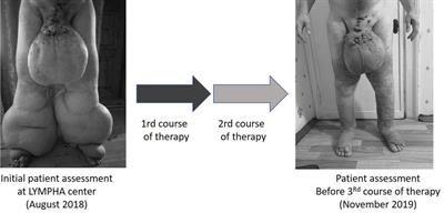 Combination of conservative and surgical methods in the treatment of giant lymphedema of the scrotum: A case report